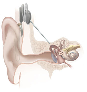 Tonos - Programmable Cochlear Implant